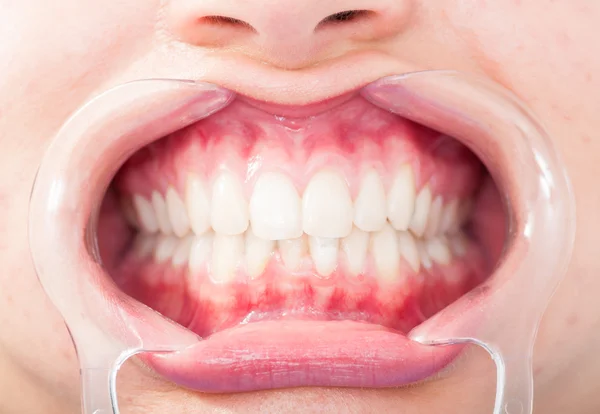 Kadın beyaz dişlerin ön görünümü yakın çekim — Stok fotoğraf