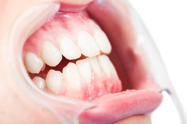 Primo piano della vista laterale della cavità del paziente femminile e dei denti — Foto Stock