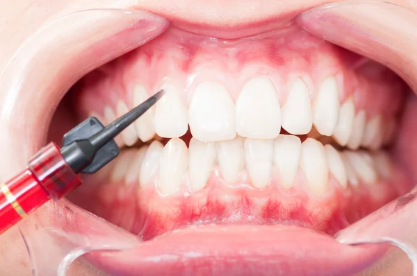 Zbliżenie z przodu Widok zębów pacjenta leczenie dotknięte — Zdjęcie stockowe