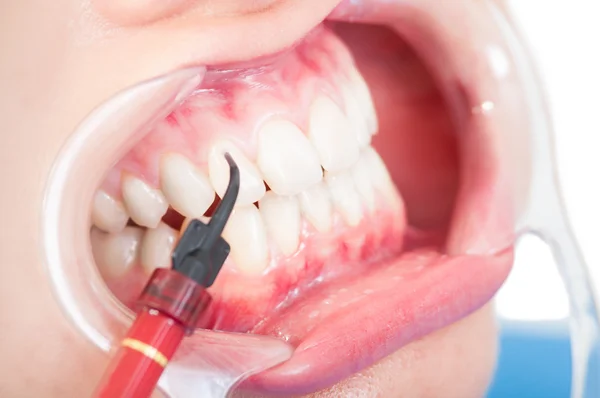 Крупним планом жіночий рот з рефрактором і композитним — стокове фото
