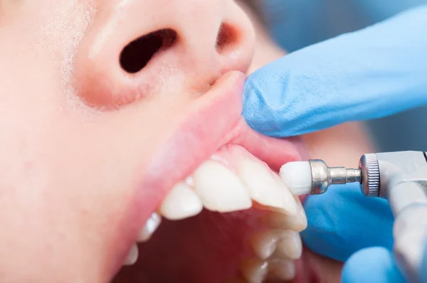 Mulher paciente escovou os dentes em close-up no consultório odontológico — Fotografia de Stock