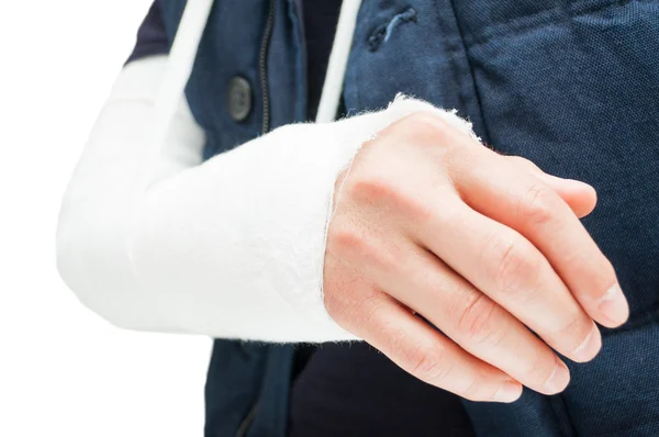 Broken elbow with medical bandage or gypsum — Stock Photo, Image