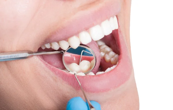 Zahnarztspiegel spiegelt Zähne wider — Stockfoto