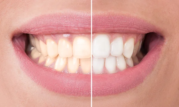 Before and after bleaching — Stock Photo, Image