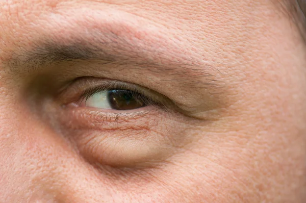 Eyesore, inflammation or bag swelling under eye — Stock Photo, Image