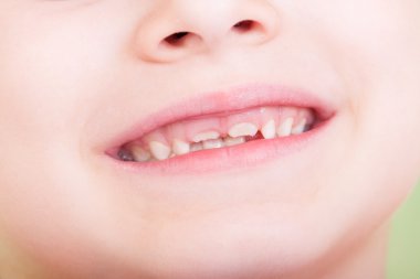 Çocuk ağız büyüyen yeni dişleriyle closeup