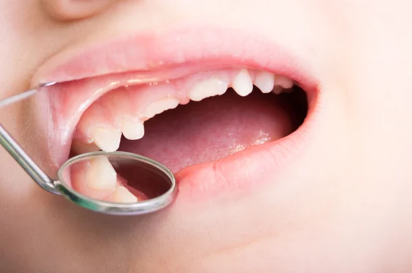 Dentes infantis examinados pelo dentista — Fotografia de Stock