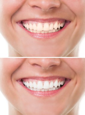 Önce ve sonra ağartma veya beyazlatma