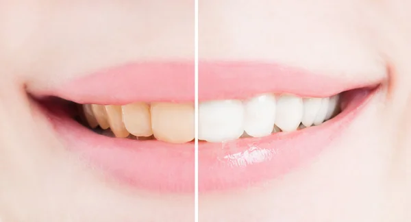 Белые зубы после отбеливания или отбеливания — стоковое фото