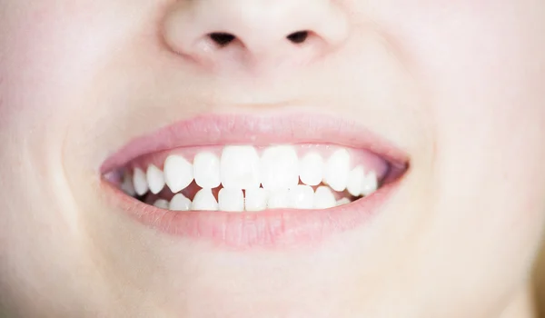 Young white smile after bleaching — Stock Photo, Image