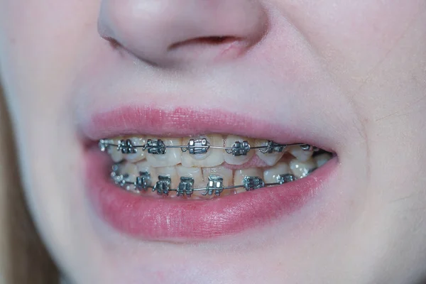 Nettes Junges Mädchen Mit Zahnspange Mädchen Teenager Lächeln Aus Nächster — Stockfoto