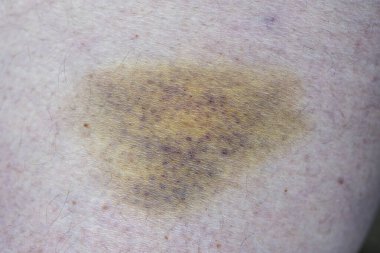 Yaralı adamın bacağındaki morluğu kapat.