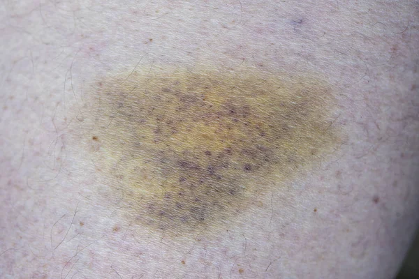 Κοντινές Μελανιές Τραυματισμένο Δέρμα Ποδιού — Φωτογραφία Αρχείου