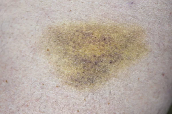 Κοντινές Μελανιές Τραυματισμένο Δέρμα Ποδιού — Φωτογραφία Αρχείου