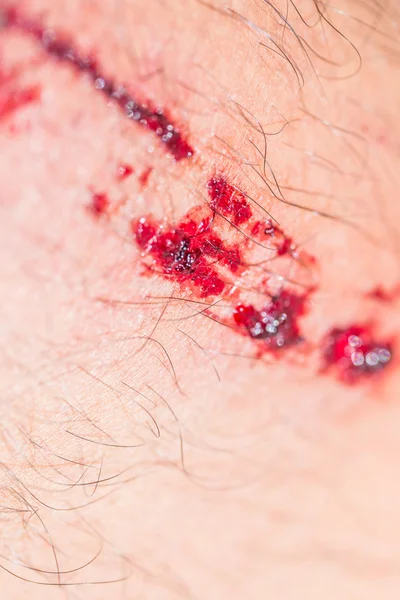 Blessure, plaies fraîches — Photo