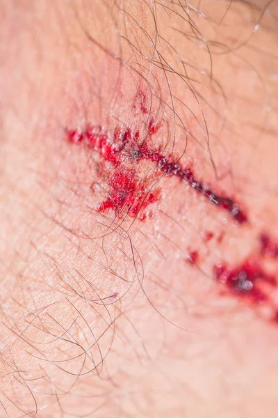 인간의 피 묻은 상처 — 스톡 사진