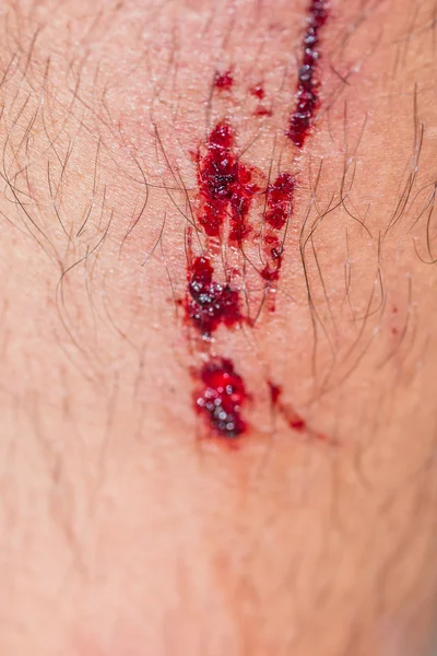 Blessure sanglante humaine — Photo