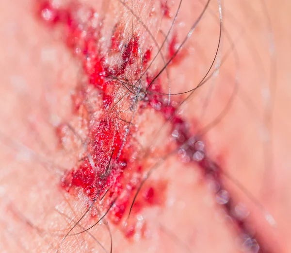 인간의 피 묻은 상처 — 스톡 사진
