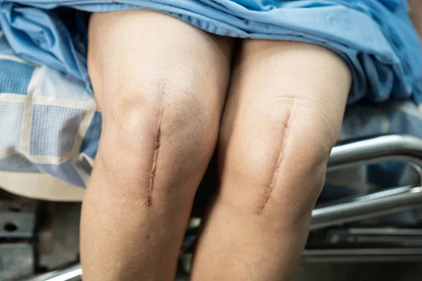 Asiática Senior Anciana Anciana Mujer Paciente Mostrar Sus Cicatrices Cirugía — Foto de Stock