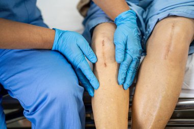 Asyalı yaşlı ya da yaşlı kadın hasta yaralarını gösteriyor. Diz eklemi ameliyatıyla değiştirilmiş. Hemşirelik hastanesi koğuşunda yatağında eklem iltihabı var..