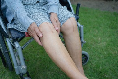 Asyalı yaşlı ya da yaşlı kadın hasta yaralarını gösteriyor. Diz eklemi ameliyatıyla değiştirilmiş. Hemşirelik hastanesi koğuşunda yatağında eklem iltihabı var..