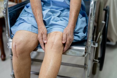 Asyalı yaşlı ya da yaşlı kadın hasta yaralarını gösteriyor. Diz eklemi ameliyatıyla değiştirilmiş. Hemşirelik hastanesi koğuşunda yatağında eklem iltihabı var..