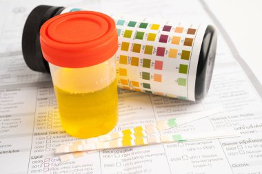 İdrar tahlili, reaksiyonlu idrar kabı. PH kağıt testi ve karşılaştırma tablosu laboratuvarda..