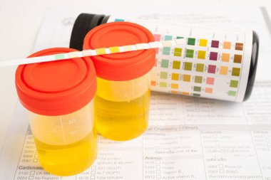 İdrar tahlili, reaksiyonlu idrar kabı. PH kağıt testi ve karşılaştırma tablosu laboratuvarda..