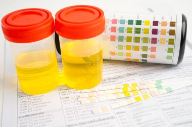 İdrar tahlili, reaksiyonlu idrar kabı. PH kağıt testi ve karşılaştırma tablosu laboratuvarda..