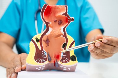 Hastanede rektum ve hemoroit insan anatomisi modeli olan Asyalı bir doktor vasküler yapısında iltihaplanma var..