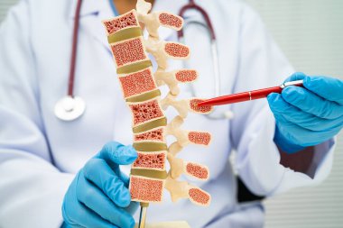 Doktor kemik modelinde osteoporoz tutuyor..