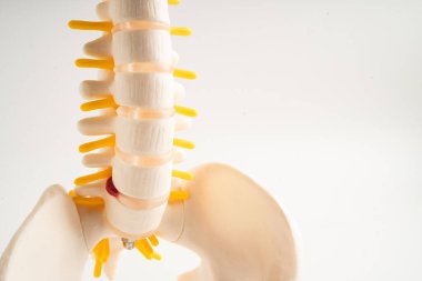 Bel omurgası yerinden oynamış disk parçası, omurilik ve kemik. Ortopedi bölümünde tedavi için model.