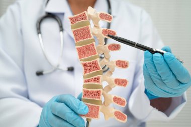 Doktor kemik modelinde osteoporoz tutuyor..