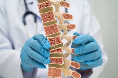 Doktor kemik modelinde osteoporoz tutuyor..