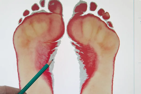 Le médecin signale les signes de pieds plats. Les médecins donnent un gant pointant vers l'empreinte avec un pointeur. Plantographie — Photo