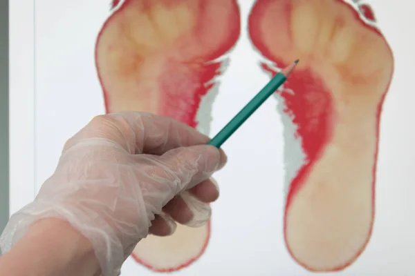 Der Arzt weist auf die Anzeichen von Plattfüßen hin. Die Ärzte reichen einen Handschuh ein, der mit einem Zeiger auf den Fußabdruck zeigt. Plantographie — Stockfoto