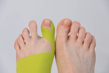 Ayaklar yakın çekim, üst manzara. Baş parmağında bir tıkırtı var. Parmak deformasyonunun düzeltilmesi. Hallux valgus. Yenilikçi tıp