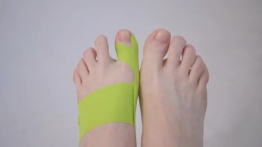 Ayaklar yakın çekim, üst manzara. Baş parmağında bir tıkırtı var. Parmak deformasyonunun düzeltilmesi. Hallux valgus. Yenilikçi tıp