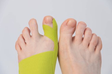 Baş parmağın düzeltilmesi. Haliux valgus. Düz tabanlı bant. Parmakları deforme olduğunda kaydediyor. Yenilikçi tıp.