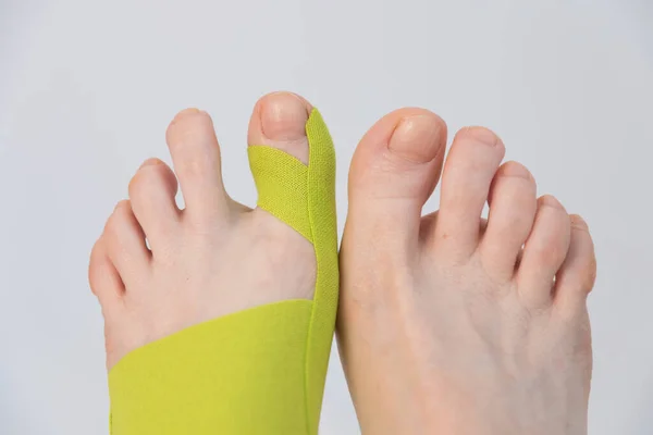 Correction of the big toe. Haliux valgus. Taping with flat feet. Taping when fingers are deformed. Innovative medicine. — Stock Photo, Image