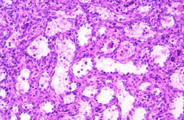 İnsan dalağı. Kırmızı hamurlu. İki ana bileşeni gösteren ışık mikroskobu mikroskobu: kan dolu dalak sinüzoidleri ve demir pigmentli makrofajları gösteren Billroth kabloları. Birincil işlevi antijenlerin kanlarını filtrelemek.