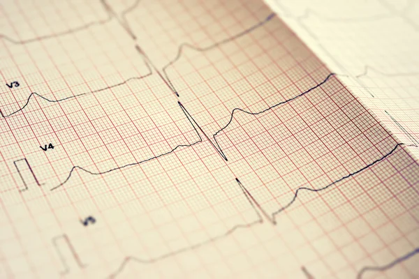 Eletrocardiograma — Fotografia de Stock