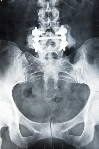 radiography of the back where you can see the nails and put plates in a surgery