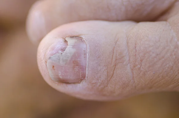 Infecção fúngica na unha dos pés — Fotografia de Stock