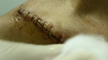 Omzundan yara yıkama