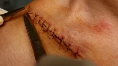 Omzundan yara yıkama