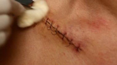 Omzundan yara yıkama