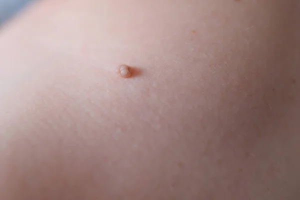 Velký Nevus Ženském Rameni Žena Návštěvě Lékaře Dermatolog Koncepce Benigních — Stock fotografie