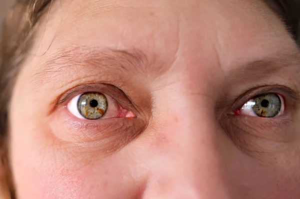 Inflamed Gray Eyeswith Spots Iris Wrinkles Eyelids Close Human Vision — Stok Foto