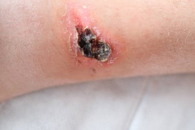 Yetişkin bir erkek hastanın bacağındaki ciddi yanık, kızarıklık, deri yaralanması, tıbbi bakım, insan dokusu yenilenmesi.